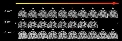 Imaging Biomarkers for Neurodegeneration in Presymptomatic Familial Frontotemporal Lobar Degeneration